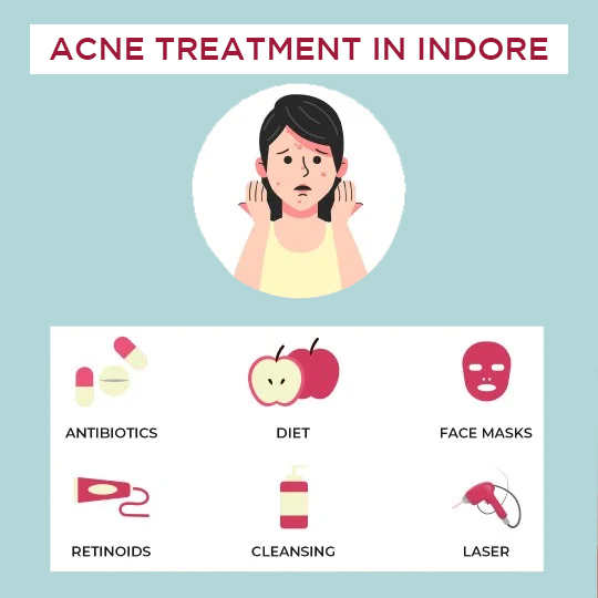 Acne Treatment in Indore -  Treatments options available: Antibiotics therapy, Carbon laser peel and Laser treatment.